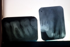 Rentgenové snímky poškozených zubů